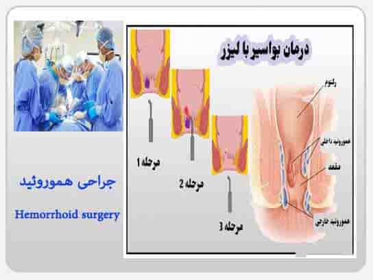 جرحی بواسیر-جراحی شقاق